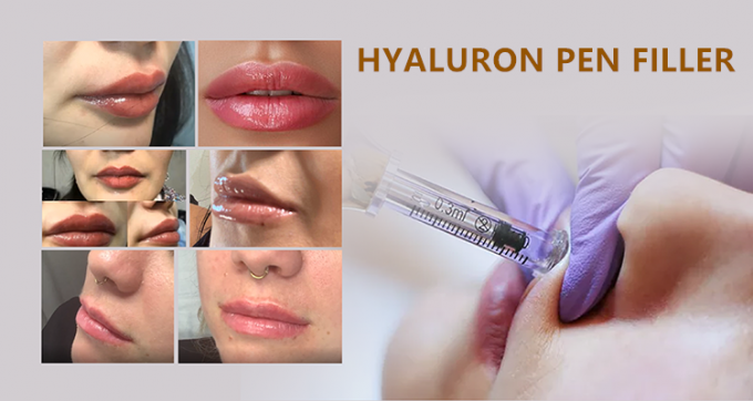 hyaluronic кисловочные впрыски заполнителей губы заполнителей hyaluronic кисловочные на обработка 2 ручки и микро-иглы